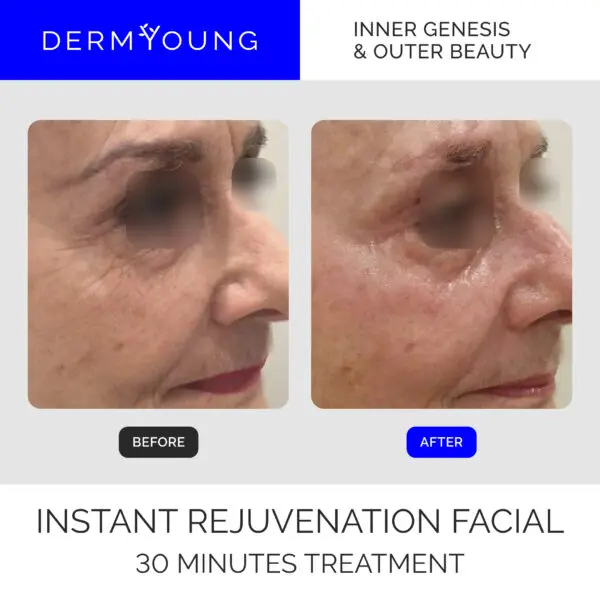 Before and after facial rejuvenation treatment.