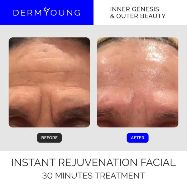 Before and after facial rejuvenation treatment.