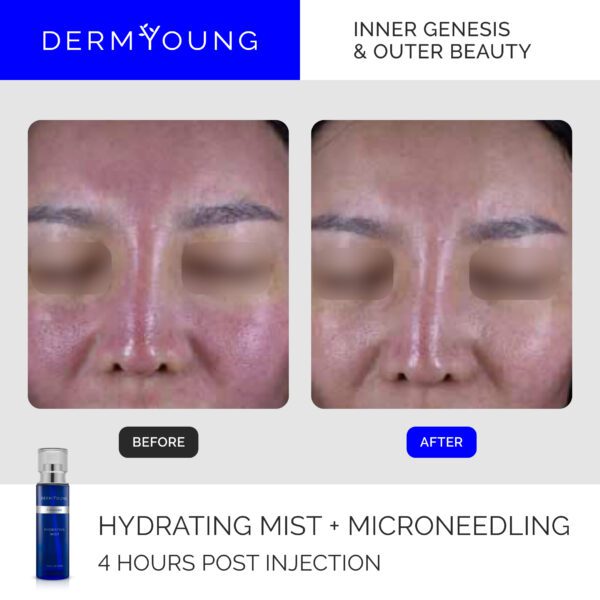 Before and after microneedling treatment.