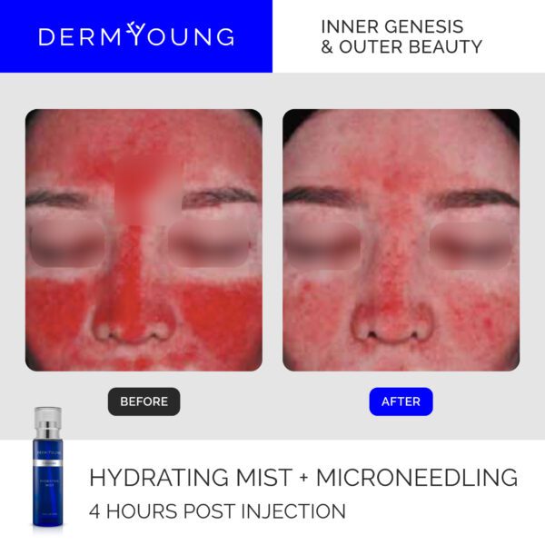 Before and after microneedling treatment.