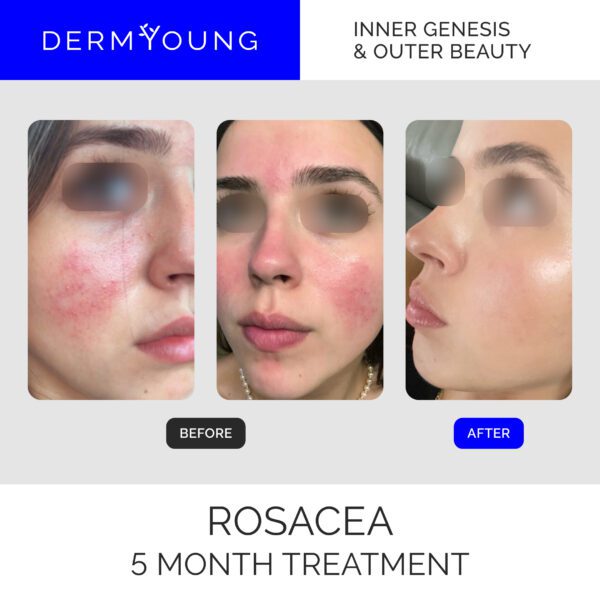 Rosacea treatment before and after 5 months.