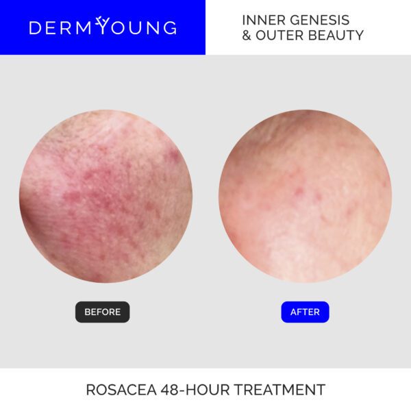 Rosacea treatment before and after results.