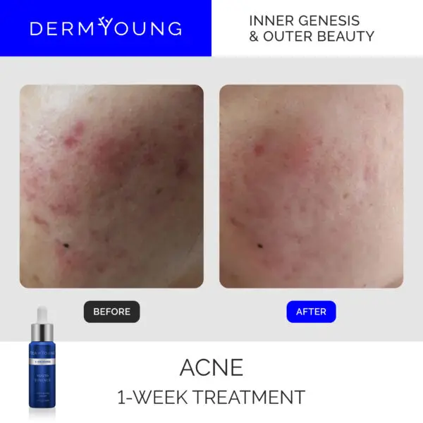 Acne before and after 1-week treatment.