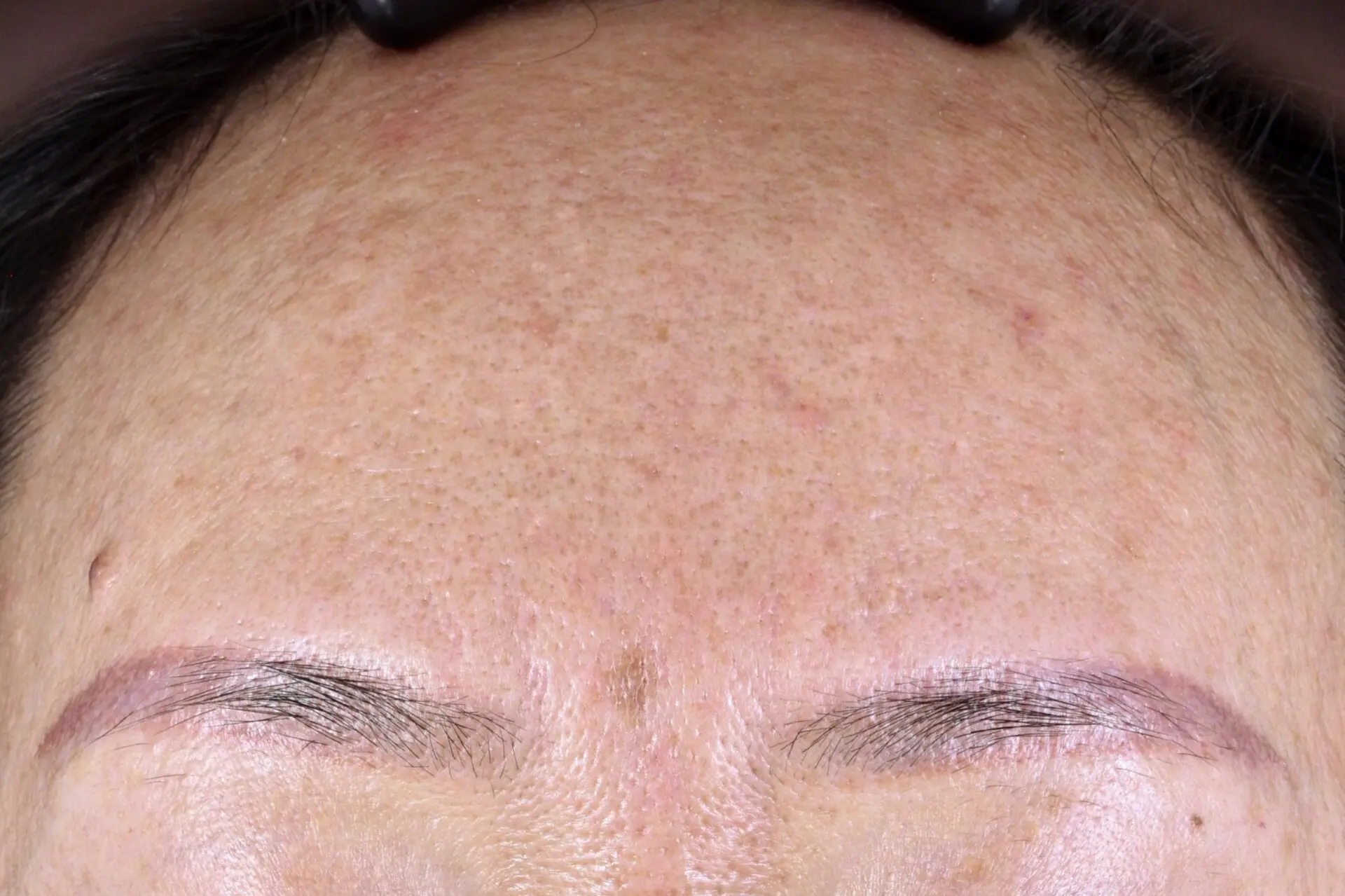 A woman with very large forehead lines and wrinkles