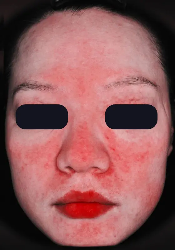 A woman with red spots on her face.