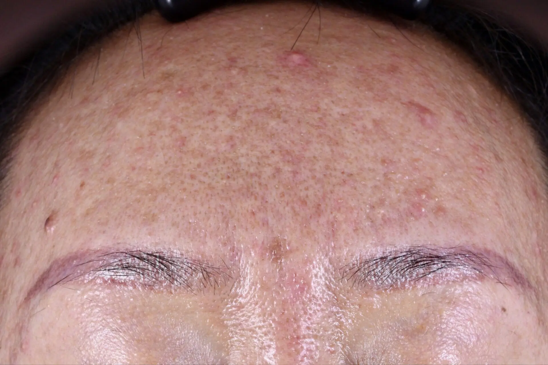 A man with acne on his forehead and face.