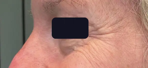 A picture of the eye area with a black square on it.