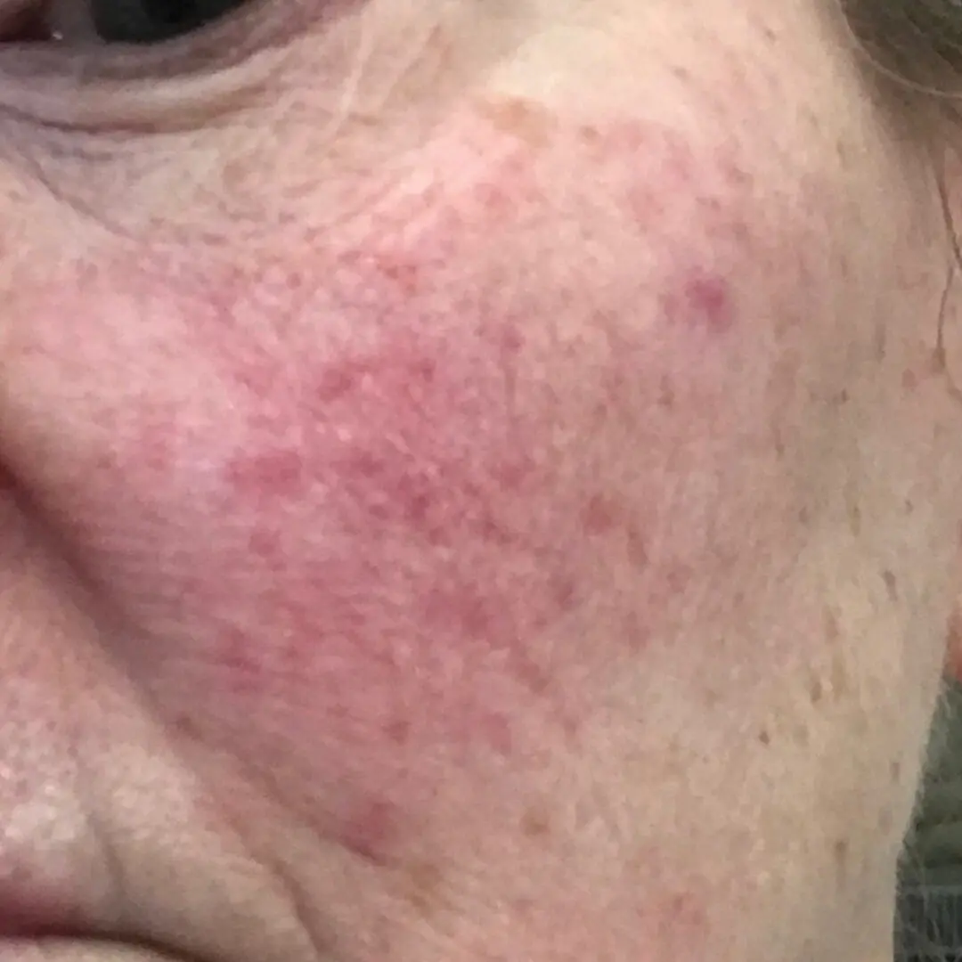 A woman with red spots on her face.