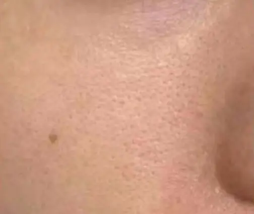 A close up of the skin on a person 's face