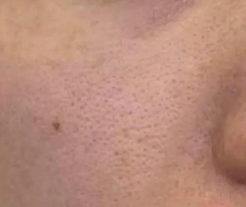 A close up of the skin on a person