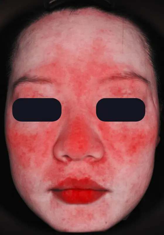 A woman with red spots on her face.