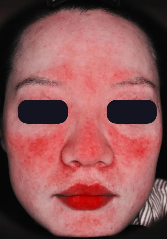 A woman with red spots on her face.