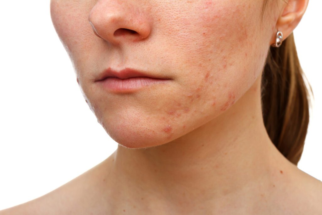 A woman with acne on her chin and neck.