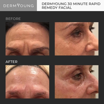 A woman 's face before and after using dermyoung 3 0 minute rapid remedy facial.