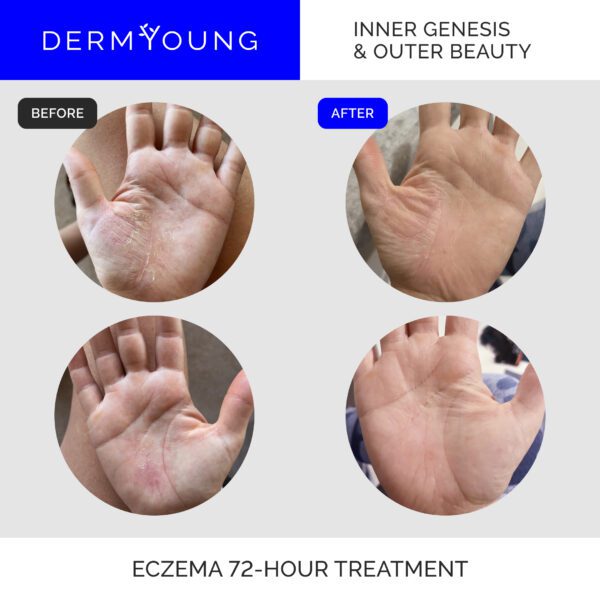 Eczema treatment before and after 72 hours.