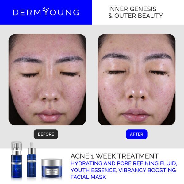 A woman with acne and skin blemishes before and after using the derm young system.