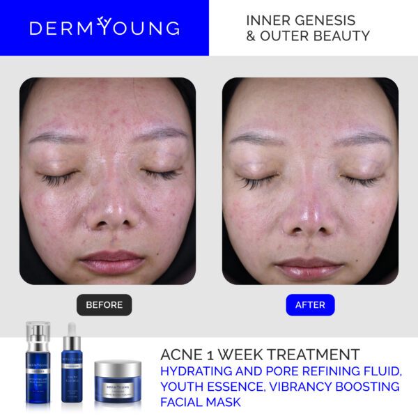 A woman with acne and the results of her derm young treatment.