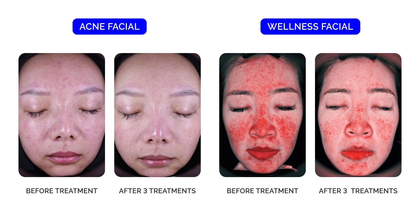 Facial before and after treatment comparison.